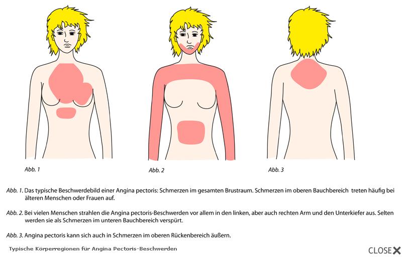 Typische Körperregionen für Angina Pectoris-Beschwerden