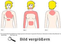 Angina Pectoris Schmerz