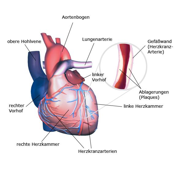 fortgeschrittene Arteriosklerose